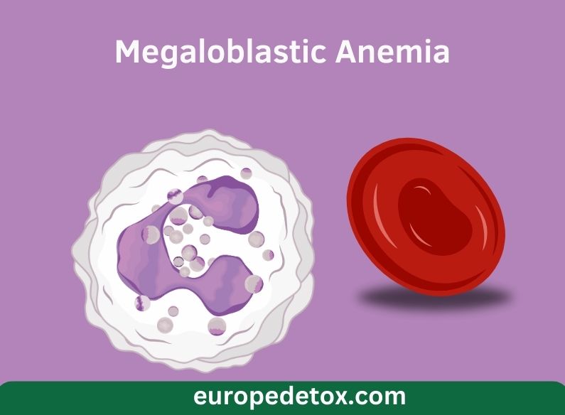 Megaloblastic Anemia